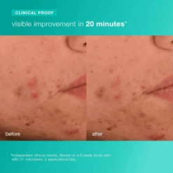 Dermalogica Acne Biotic Moisturizer 1.7oz / 50ml 11 Dermalogica Acne Biotic Moisturizer 1.7oz / 50ml -Skin Care By Alana acnebioticmoisturizer3