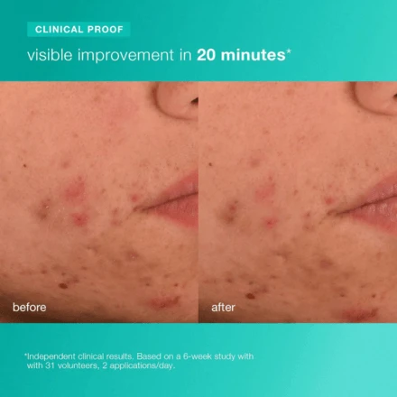 Dermalogica Acne Biotic Moisturizer 1.7oz / 50ml 4 Dermalogica Acne Biotic Moisturizer 1.7oz / 50ml - Image 4