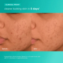 Dermalogica Acne Biotic Moisturizer 1.7oz / 50ml 12 Dermalogica Acne Biotic Moisturizer 1.7oz / 50ml -Skin Care By Alana acnebioticmoisturizer4