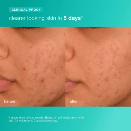 Dermalogica Acne Biotic Moisturizer 1.7oz / 50ml 5 Dermalogica Acne Biotic Moisturizer 1.7oz / 50ml - Image 5