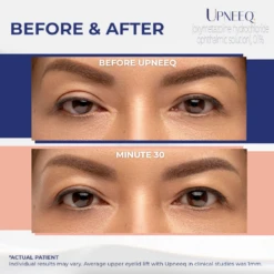 Upneeq Eye Drops - 30 Vials -Skin Care By Alana upneeqresults